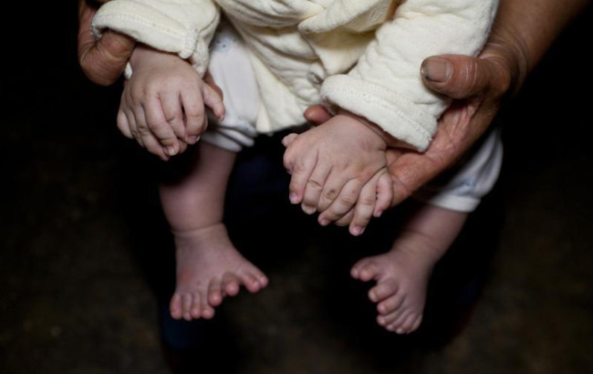 3個月大男嬰患多指症 手指腳趾總共31根